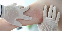متى يكون طفح مخدرات أكثر من مجرد طفح جلدي؟