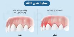 عملية قص اللثة إجراء طبي أم تجميلي.. إليك الدواعي والمخاطر