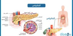 السكري من النوع الثالث … عندما يكون الخلل في البنكرياس نفسه