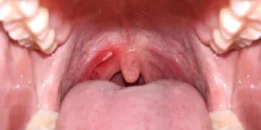 حتى مشروبًا واحدًا يوميًا قد يزيد من خطر الإصابة بسرطان الفم