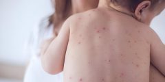 هل يُنذِر ارتفاع حالات الحصبة عالميًا بأزمة صحية جديدة؟