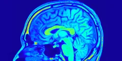 قد تؤدي فحوصات الدماغ أخيرًا إلى إنهاء التخمين في علاج الاكتئاب
