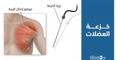 كيف تؤخذ خزعة العضلات وما الأمراض التي تشخصها؟