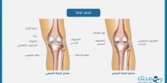 متلازمة الألم الرضفي الفخذي: ألم الركبة الصامت