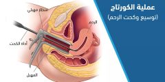 هل عملية الكورتاج آمنة، وكيف تتم، وما دواعي إجرائها؟