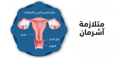 ما هي متلازمة أشرمان وما أعراضها وكيف يمكن علاجها؟
