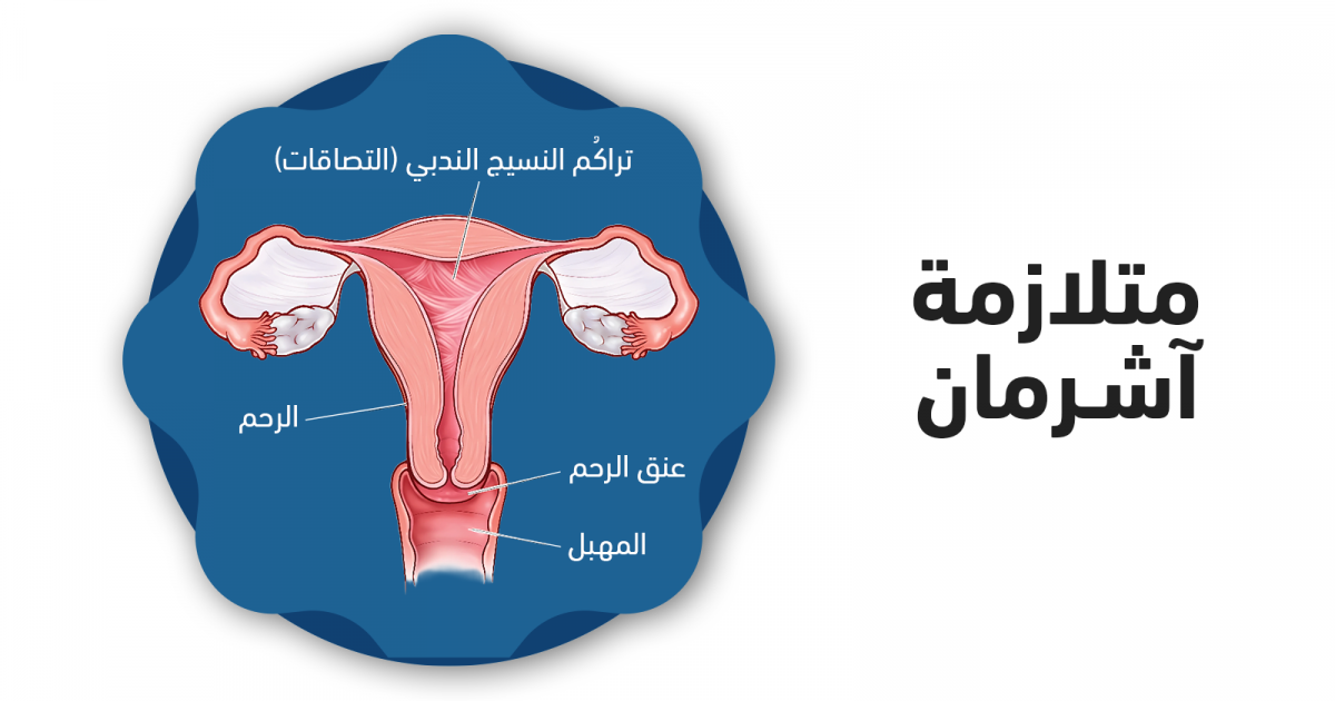 ما هي متلازمة أشرمان وما أعراضها وكيف يمكن علاجها؟