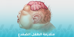 ما هي متلازمة الطفل الضفدع وهل هي مميتة؟