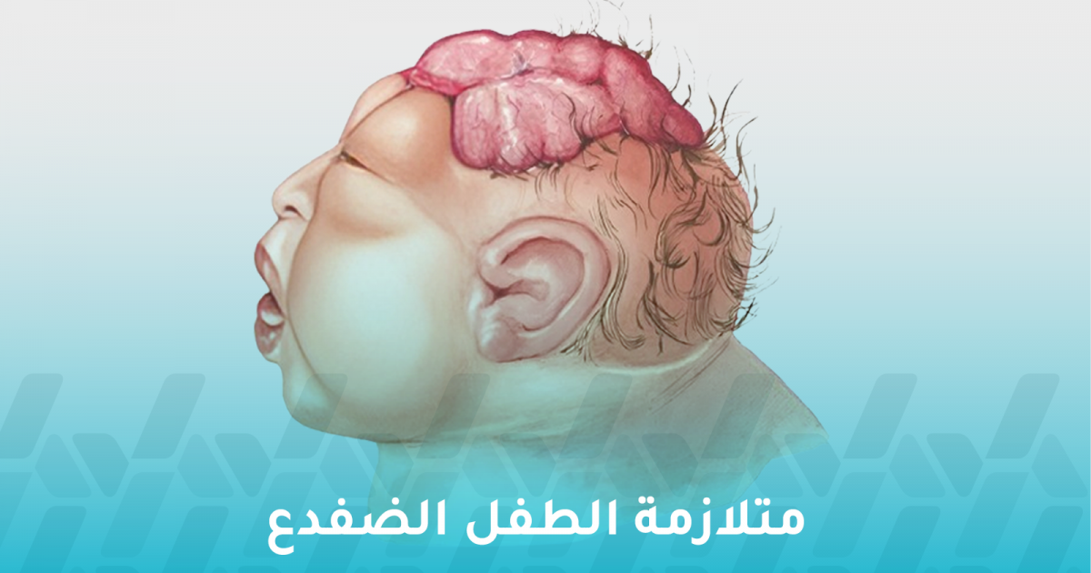 ما هي متلازمة الطفل الضفدع وهل هي مميتة؟