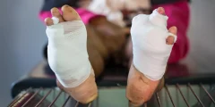 هلام الأكسجين الجديد يمكن أن يمنع بتر الأطراف لدى مرضى الجروح المصابة بالسكري