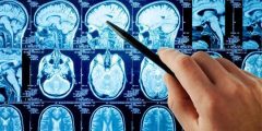 الشلل البصلي المتزايد: الأعراض والأسباب وطرق العلاج