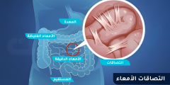 ما هي أسباب التصاقات الأمعاء وهل تعود الالتصاقات بعد العلاج؟