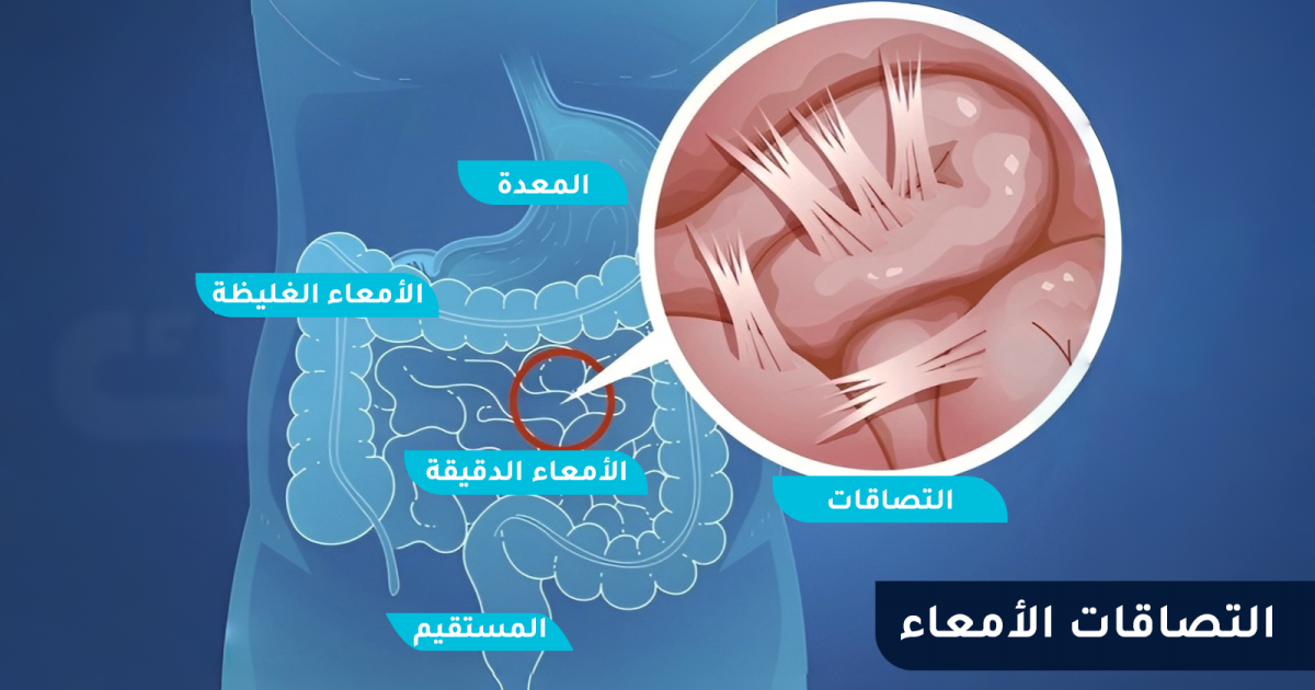 ما هي أسباب التصاقات الأمعاء وهل تعود الالتصاقات بعد العلاج؟