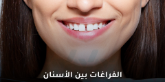 الفراغات بين الأسنان: هل هي حالة طبية بحاجة إلى علاج؟