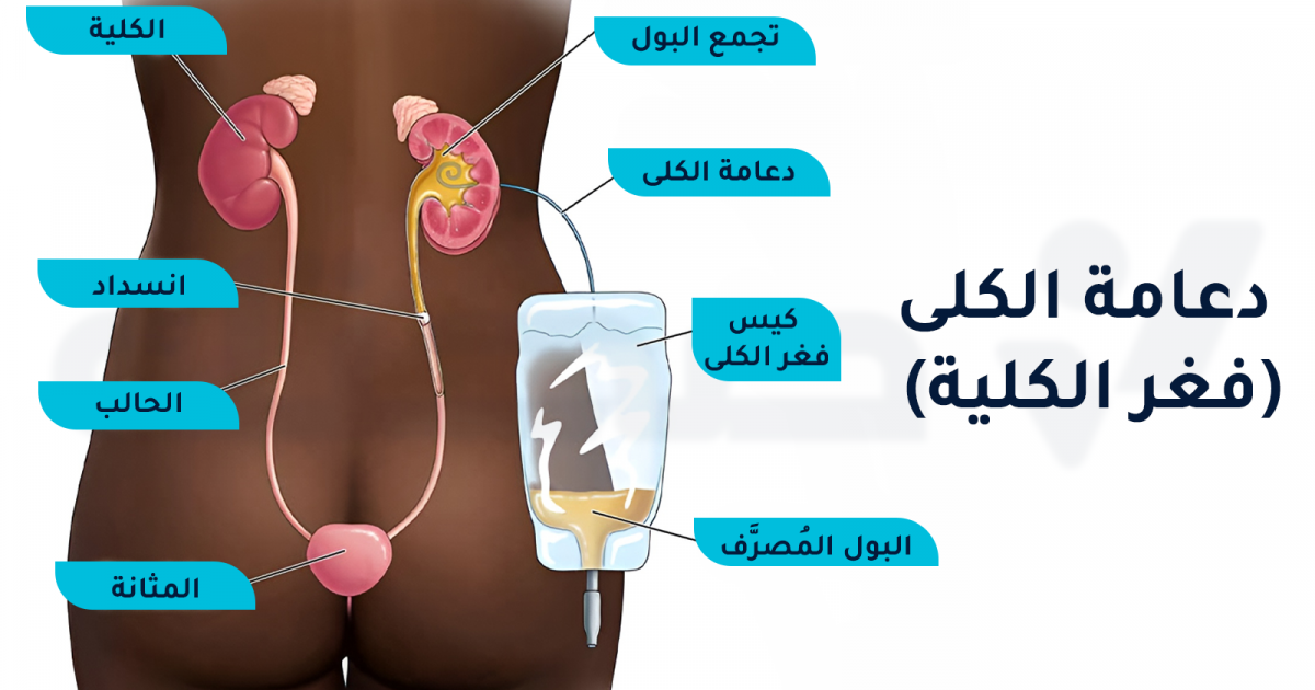 دعامات الكلى: ما دواعي استخدامها وكم تبقى في الجسم؟