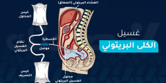 غسيل الكلى البريتوني: ما هي مميزاته وعيوبه ومتى يستخدم؟