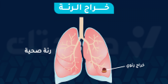 هل يتم الشفاء من خراج الرئة وما هي أعراضه؟