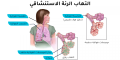 هل يمكن الشفاء من التهاب الرئة الاستنشاقي وما مضاعفاته؟