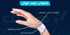 التهاب غمد الوتر: الأسباب والأعراض وطرق العلاج