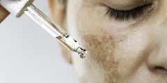 طرق علاج الكلف وكيفية الحفاظ على نتائج العلاج