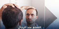 كل ما ينبغي معرفته عن الصلع عند الرجال وتأثيره عليهم