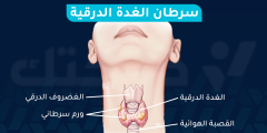 ما هي أعراض سرطان الغدة الدرقية وما نسبة الشفاء منه؟