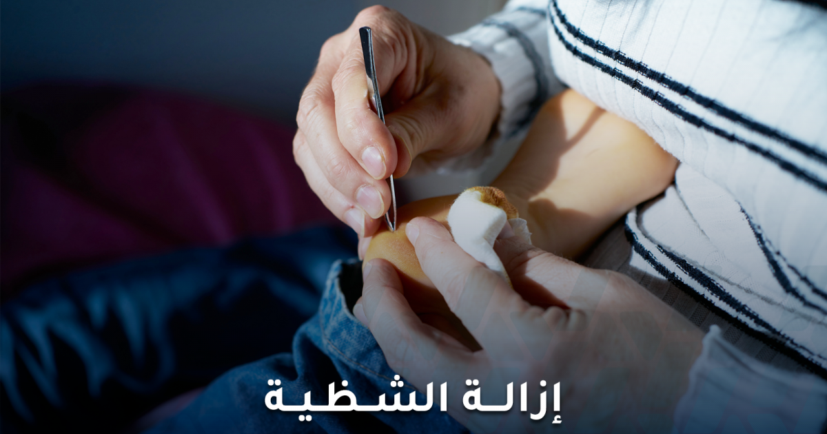 إزالة الشظية أو أي جسم غريب من الجلد بطرق سهلة وآمنة