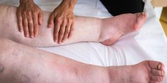 فوائد المساج الليمفاوي لمرضى الليبيديما وكيف يعمل؟