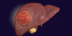 قد يساعد الدواء المعتمد من إدارة الغذاء والدواء (FDA) أخيرًا العلاج المناعي في التغلب على سرطان الكبد النادر