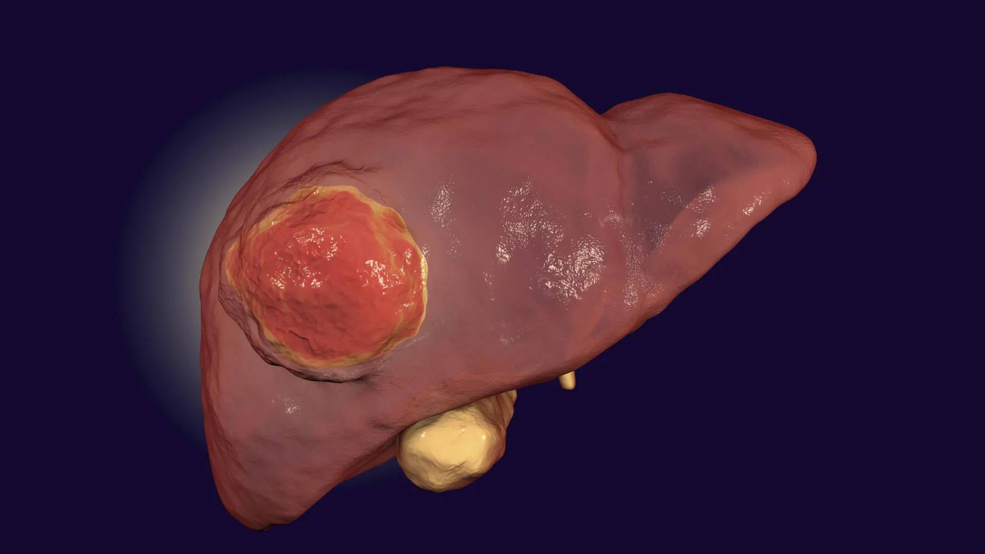 قد يساعد الدواء المعتمد من إدارة الغذاء والدواء (FDA) أخيرًا العلاج المناعي في التغلب على سرطان الكبد النادر