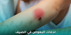 لدغات البعوض في الصيف متى تكون إزعاجًا ومتى تستدعي الانتباه؟