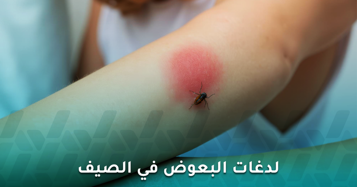 لدغات البعوض في الصيف متى تكون إزعاجًا ومتى تستدعي الانتباه؟