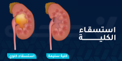 هل استسقاء الكلية خطير؟ وكيف يتم علاجه وما الأعراض والأسباب؟