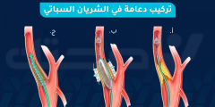 تركيب دعامة الشريان السباتي يقلل خطر الإصابة بالسكتة الدماغية