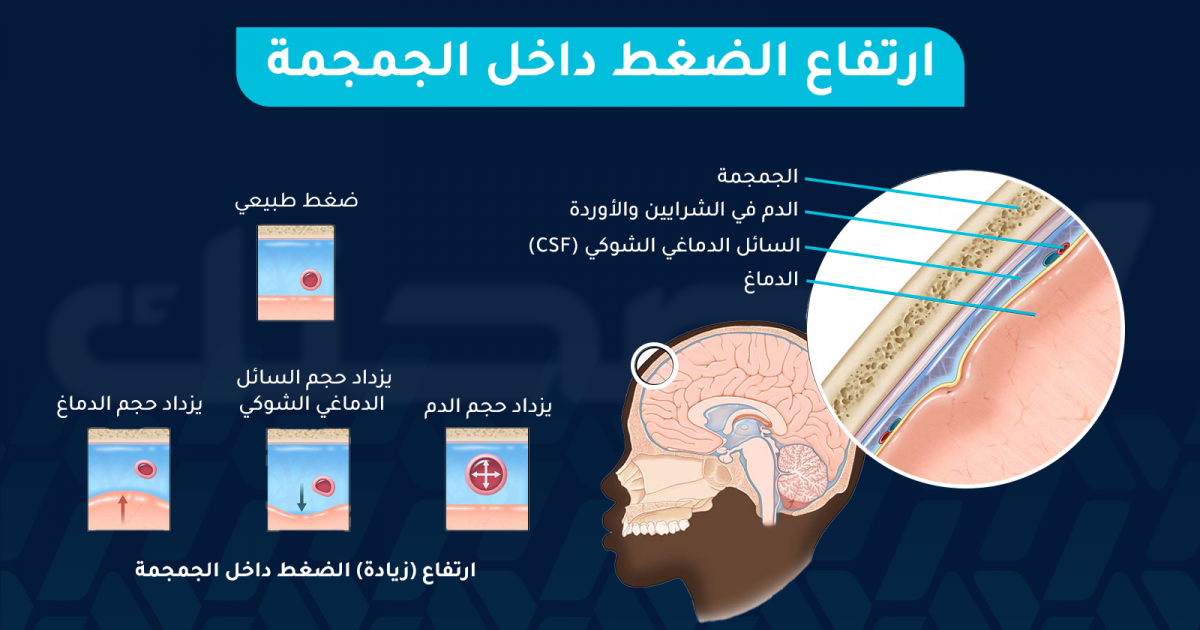 هل ارتفاع الضغط داخل الجمجمة حالة طبية خطيرة تحتاج تدخلًا؟